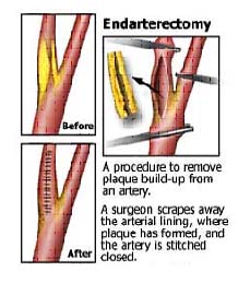 India Surgery Carotid Endarterectomy,Cost Carotid Endarterectomy, Carotid Endarterectomy Surgery India