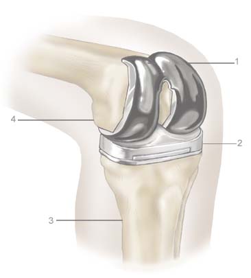 India Surgery Bilateral Knee Replacement Surgery, India Bilateral Total Knee