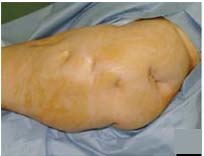 India Surgery Simultaneous Bilateral Hip Replacement Resurfacing