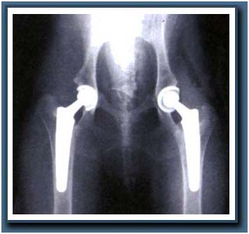 India Surgery Simultaneous Bilateral Hip Replacement Resurfacing, Simultaneous Bilateral Hip Replacement Surgery