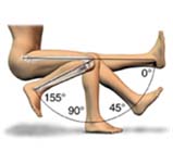 India Cost High Flex Knee, High Flex Knee Replacement, High Flex Knee Replacement Procedure