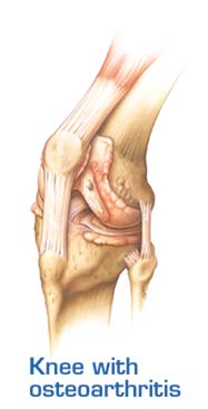 India Surgery High Flex Knee Replacement, High Flex Knee Replacement, High Flex Knee Replacement Procedure