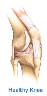  High Flex Knee Replacement, High Flex Knee Replacement Procedure
