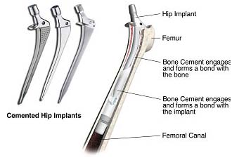 India surgery hip replacement