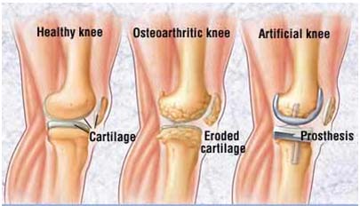 India Cost Knee Replacement Surgery
