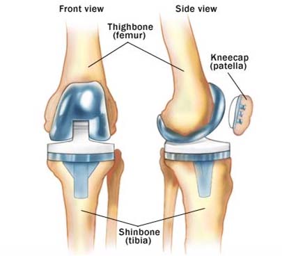 india cost knee replacement surgery