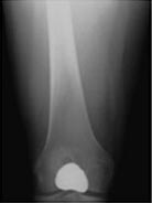 India Surgery Patello Femoral Replacement, Patello Femoral Replacement Surgery