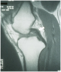 India Surgery PCL Reconstruction, India Cost Anterior Cruciate Ligament, Pcl, Reconstruction Surgery