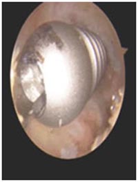 India Surgery Revision ACL Reconstruction Surgery, Cost ACL Revision