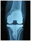 India Surgery Revision Knee Replacement, Cost Knee Revision Surgery