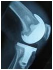 India Surgery Revision Knee Replacement, Revision Knee Replacement, Repeat Knee Replacement