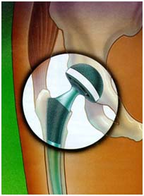 India Surgery Total Hip Replacement, Cost Total Hip Replacement Surgery