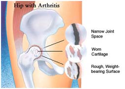 India Surgery Total Hip Replacement, Total Hip Replacement Surgery