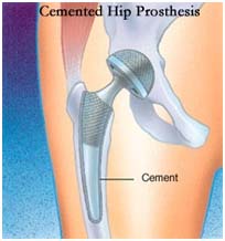 India Surgery Total Hip Replacement, Cost Total Hip Replacement Surgery, Hip Surgery