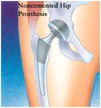India Surgery Total Hip Replacement, Hip Surgery