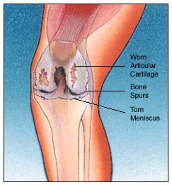 India Cost Total Knee Replacement, Total Knee Replacement Surgery, India TKR