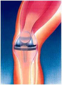 India Surgery Total Knee Replacement, India Cost Total Knee Replacement, Surgery Activities