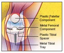 India Surgery Total Knee Replacement, India TKR, Surgery Activities