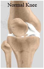 India Surgery Unicondylar Knee Replacement,India Cost Unicondylar Knee Mumbai