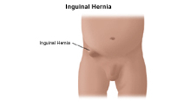 Cost Inguinal Hernia Repair Hospital