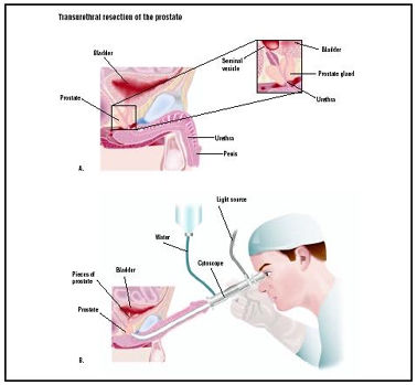India Surgery Transurethral Resection Prostate, Cost TURP Surgery India, Cost TURP Surgery Hospital