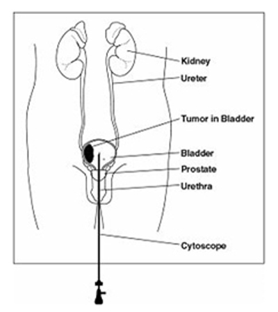 India Surgery TURBT Transurethral Resection of Bladder Tumor, India TURBT