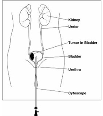 India Surgery TURBT Transurethral Resection of Bladder Tumor, India TURBT, TURBT-Transurethral Resection of the Bladder Tumor surgery
