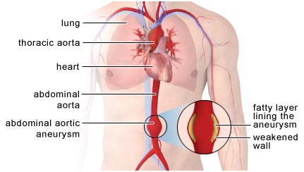 India Surgery Abdominal Aortic Aneurysm, Cost Abdominal Aortic Aneurysm