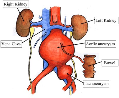India Surgery Abdominal Aortic Aneurysm, Abdominal Aortic Aneurysm Treatment, Abdominal Aortic Aneurysm Surgery