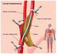 Surgery India Atherosclerotic Carotid Artery, India Cost Carotid Artery