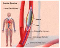 Surgery India Atherosclerotic Carotid Artery, Atherosclerotic Disease Of The Carotid Artery Treatment