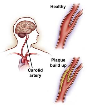 Surgery India Carotid Artery Disease, India Cost Carotid Artery Disease