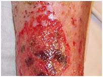 Surgery India Leg Ulcers Treatment, India Cost Lower Leg Ulceration