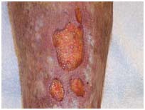 India Cost Lower Leg Ulceration, Lower Leg Ulcers Treatment, India Cost Leg Ulceration - Ethnicity