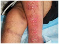 Surgery India Leg Ulcers Treatment, India Cost Leg Ulceration - Ethnicity, India Wound Management