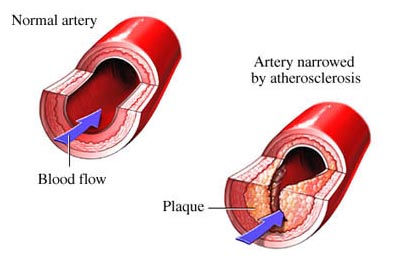 India Surgery Peripheral Vascular Surgery, Cost Peripheral Vascular