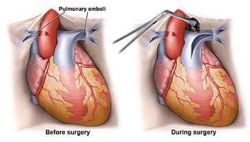 India Surgery Pulmonary Endarterectomy Surgery, Pulmonary Endarterectomy, India Pulmonary Vascular Disease