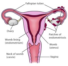 Endometriosis India, Endometriosis Infertility Surgery Treatment India, Endometriosis Infertility Symptoms, Diagnosis and Treatment India