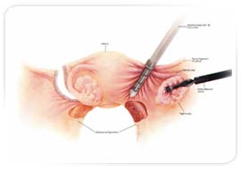 Hysterectomy, Hysterectomy India, India Laparoscopic Vaginal Hysterectomy, India Laparoscopy