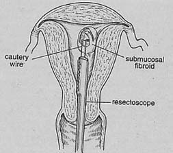 Myomectomy, Myomectomy India, Laparoscopic laser myomectomy , uterine fibroid