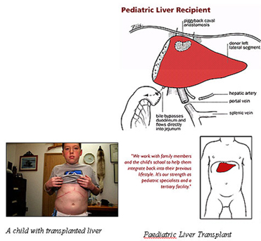 Liver Transplant Surgery India offers info on Liver Transplant Surgeon India, Liver Surgery India, Liver Transplant India, Cirrhosis India, Hepatitis India