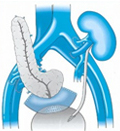 Pancreatic Transplant Surgery India offers info on Pancreas Transplant Surgery India